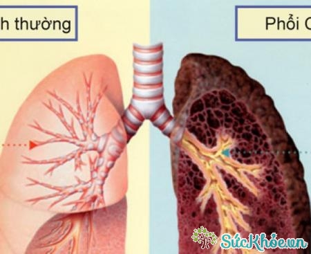 Bệnh phổi tắc nghẽn là bệnh lý tắc nghẽn không khì phổi