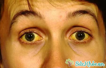 Vàng mắt, vàng da là một biểu hiện của viêm gan C mạn tính