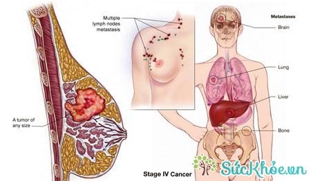 Các giai đoạn ung thư vú sẽ có đặc điểm khác nhau