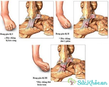 Bong gân cổ chân là chân bị thường do kéo dãn cơ