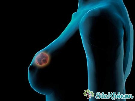Ung thư vú giai đoạn cuối thường có khối u lớn ở vú