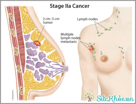 Ung thư vú giai đoạn 2 là ung thư xâm lấn