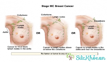 Ung thư vú giai đoạn 3 khối u đã lớn hơn 5cm