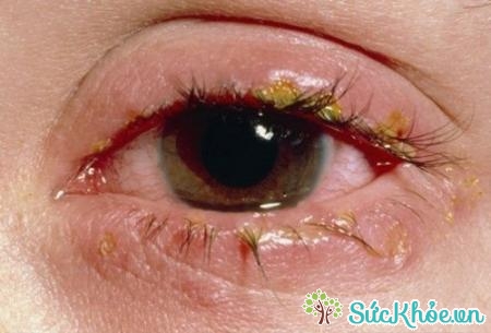 Bệnh nấm mắt có biểu hiện đau mắt, mắt đỏ