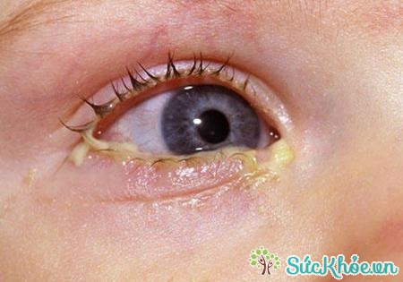 Nguyên nhân gây bệnh nấm mắt do một số loại nấm gây ra