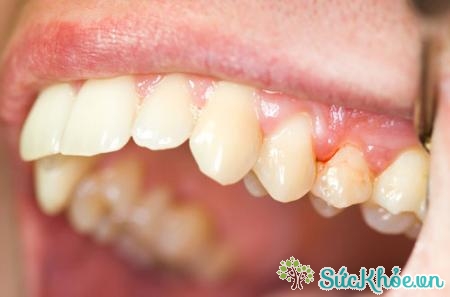Viêm nướu là nguyên nhân chính gây chảy máu chân răng ở trẻ em