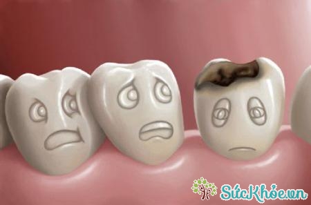 Sâu răng hàm là một căn bệnh về răng miệng phổ biến