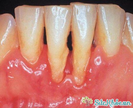 Viêm chân răng là một biểu hiện của chảy máu chân răng