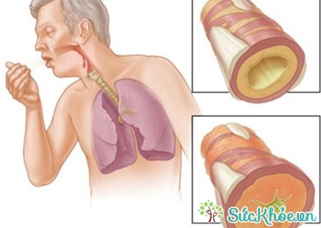 Bệnh bụi phổi có triệu chứng tức ngực, khó thở