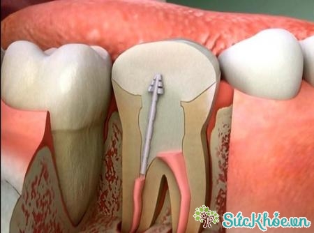 Triệu chứng viêm tủy răng còn tùy thuộc vào các thể viêm