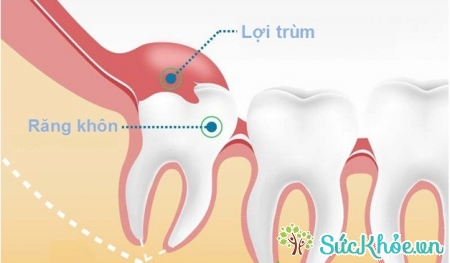 Viêm lợi trùm răng khôn là một triệu chứng của việc mọc răng khôn
