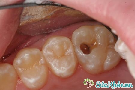 Lỗ sâu răng có thể dễ nhìn thấy ở những người bị sâu răng