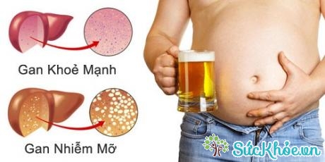 Nguyên nhân hàng đầu dẫn đến gan nhiễm mỡ là bia, rượu, đặc biệt ở nam giới rất nhiều.