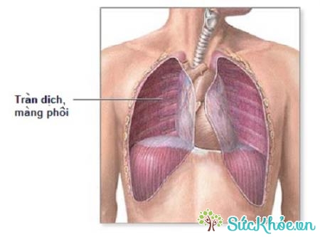 Tràn mủ màng phổi là sự tích tụ mủ trong khoang màng phổi