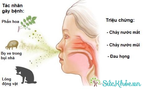 Ngứa mũi, hắt hơi, chảy nước mũi, tắc ngạt mũi... là những triệu chứng điển hình của viêm mũi dị ứng