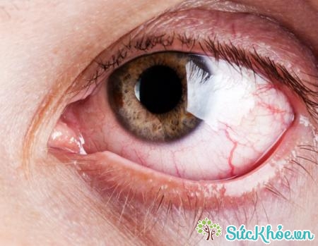 Thức đêm học bài có thê khiến một số bệnh về mắt trở nên nặng hơn.