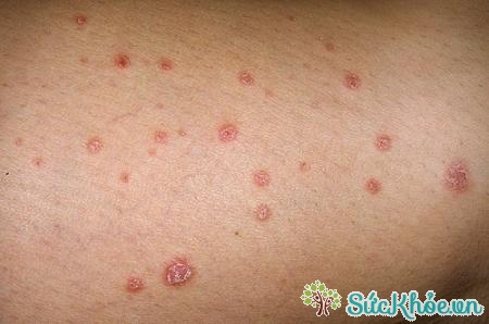 Những người có làn da rất mẫn cảm nên cẩn thận khi sử dụng các sản phẩm chống muỗi.