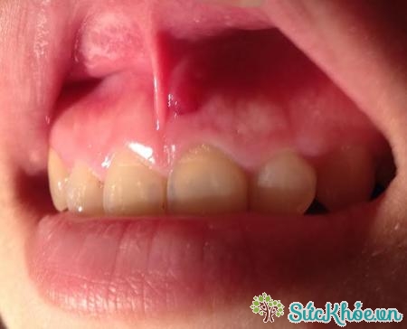 Viêm quanh răng là tình trạng nhiễm trùng lợi