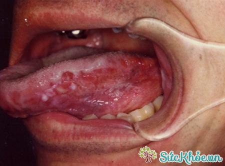 Ung thư lưỡi thường xảy ra ở nam giới trên 50 tuổi