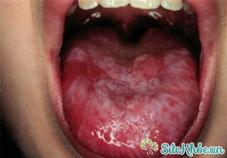 Triệu chứng của bệnh là khó nuốt và chảy máu trong miệng