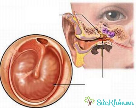Thủng màng nhĩ là hiện tượng rách màng ngăn tai ngoài và trong