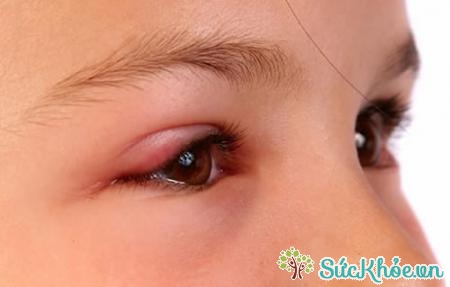 Mắt tấy đỏ và chảy nước mắt là triệu chứng đau mắt hột thường gặp 