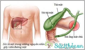 Nhiễm khuẩn đường mật là tình trạng viêm nhiễm xảy ra tại đường dẫn mật trong gan hoặc ngoài gan
