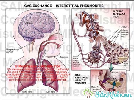 Viêm phổi kẽ có biểu hiện khó thở và nghiêm trọng theo thời gian