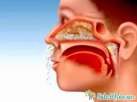Biểu hiện bệnh Polyp mũi là hiện tượng chảy nước mũi, nghẹt mui