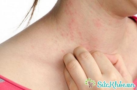 Ngứa trên da là triệu chứng chủ yếu và đầu tiên của bệnh