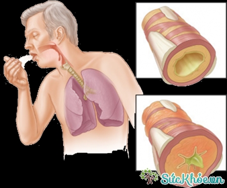 Bệnh phổi chỉ các cơ rối loạn ảnh hưởng đến phổi