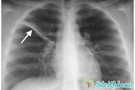 Xẹp phổi là tình trạng thùy phổi xẹp một phần hoặc hoàn toàn
