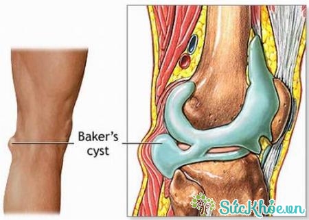 Nang hoạt dịch vùng khoeo chân thường do ảnh hưởng từ bệnh lý về khớp gối