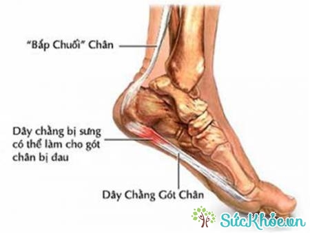 Viêm cân gan bàn chân là tình trạng cơ gân bàn chân bị sưng, viêm