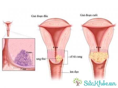 Ung thư nội mạc tử cung là khối u phát triển trong niêm mạc tử cung