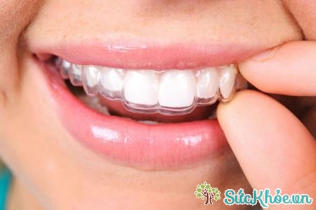 Di truyền và môi trường là hai yếu tố dẫn đến tình trạng răng thừa
