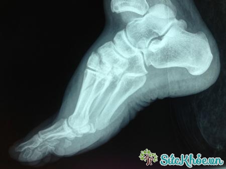 Gãy xương mắt cá chân có thể dẫn đến bong gân