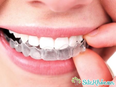 Răng thừa được biểu hiện ở bốn dạng