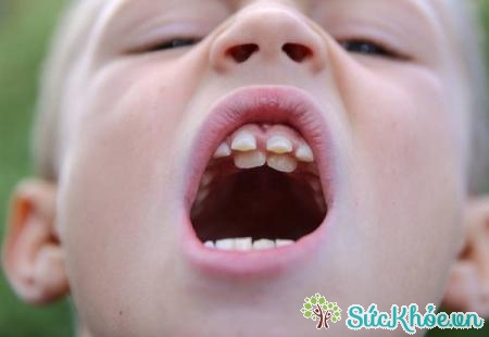 Răng thừa mọc ở bất kì đâu trong bộ răng