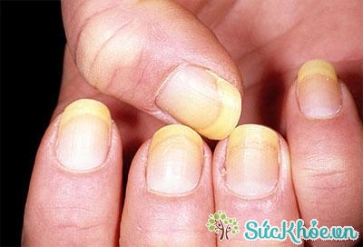 Móng tay vàng là một trong những nguyên nhân chính của việc móng tay vàng là bị nhiễm nấm
