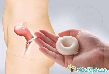 Màng ngăn âm đạo thường là cao su tái sử dụng hoặc silicone với một vành bao quanh cổ tử cung