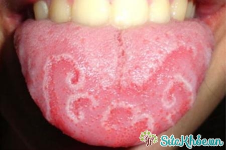 Viêm lưỡi là một tác dụng phụ khi dùng thuốc