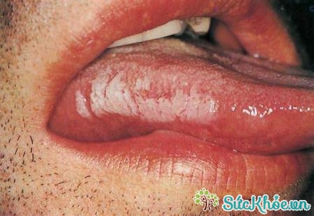 Bệnh bạch sản gây ra các mảng da dày, trắng trên lưỡi