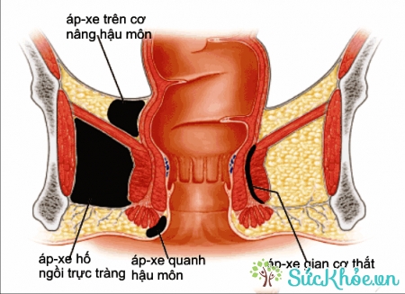 Viêm ống hậu môn là tình trạng viêm ở vùng hậu môn