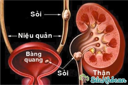 Dùng thuốc quá liều có thể gây sỏi thận