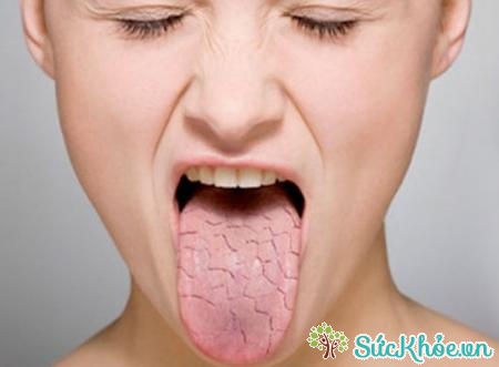 Bệnh bạch sản miệng là những mảng dày màu trắng hình thành trong miệng