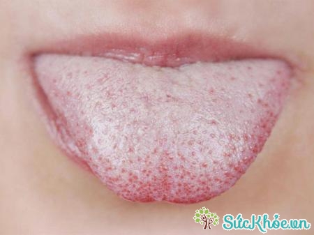 Nấm Candida thường xảy ra ở miệng, da, bộ phận sinh dục