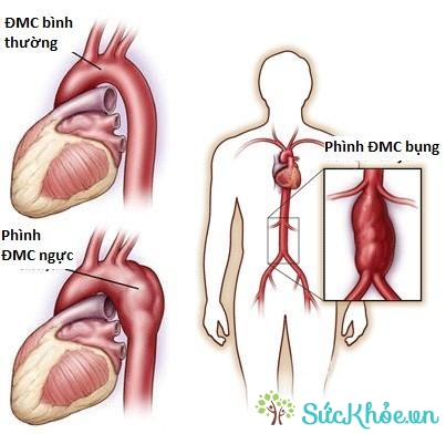 Phình động mạch chủ ngực