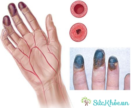 Viêm thuyên tắc mạch máu do các mạch máu vừa và nhỏ ở cánh tay bị nhiễm trùng
