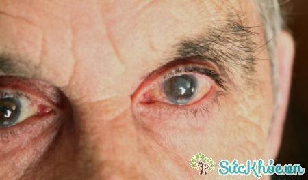 Đục thủy tinh thể là bệnh về mắt ở người già thường gặp